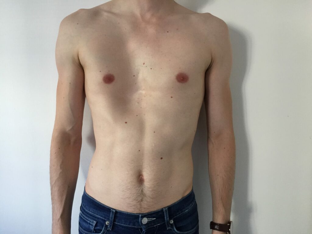 Alastair Pectus Excavatum pre-surgery