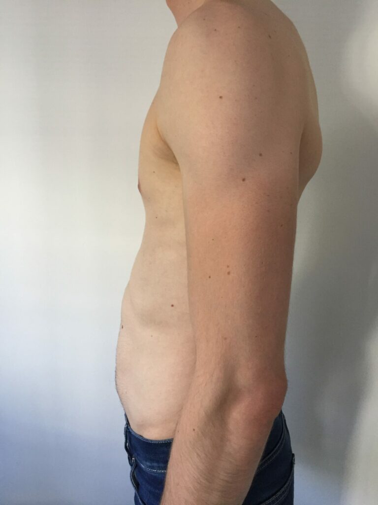 Alastair Pectus Excavatum pre-surgery