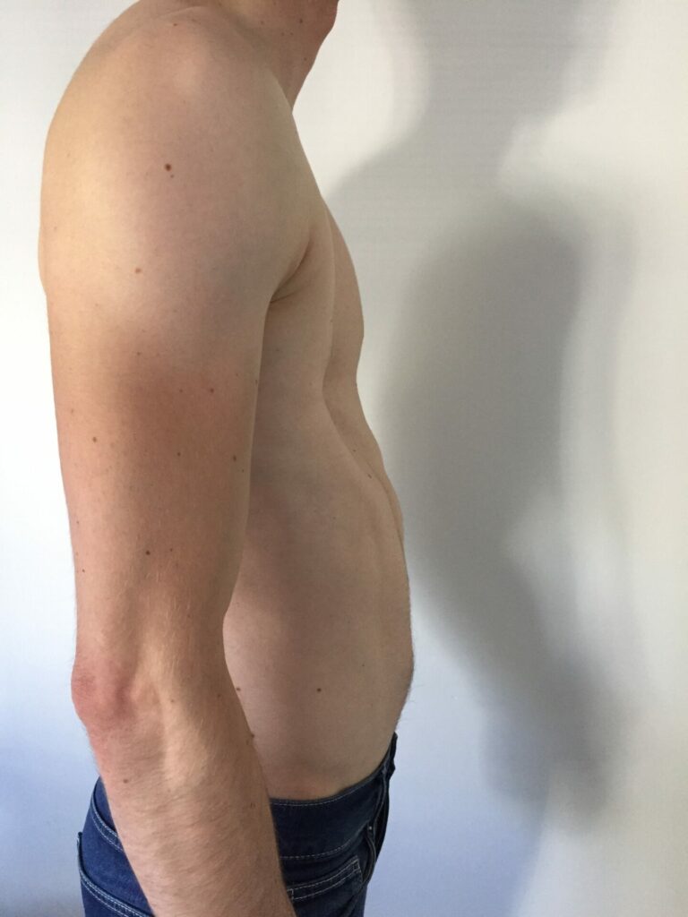 Alastair Pectus Excavatum pre-surgery