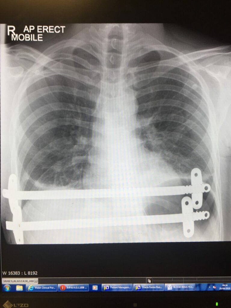 An x-ray of the bars inside Alastair's chest