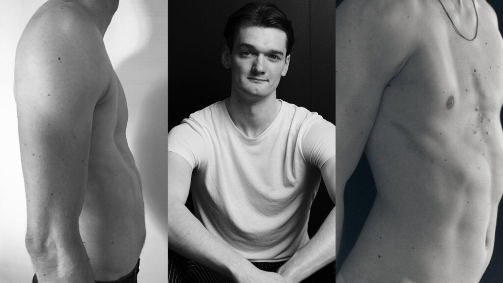 Alastair James shares his journey with Pectus Excavatum in Attitude's Real Bodies